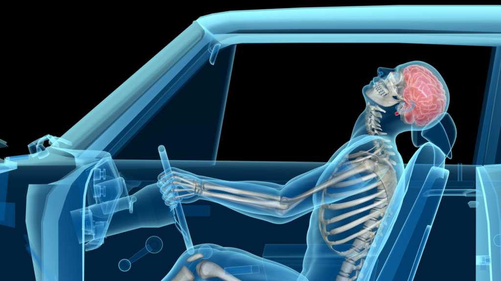 diagram-of-body-experiencing-whiplash-in-car-accident